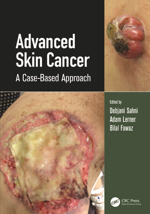  کتاب Advanced Skin Cancer